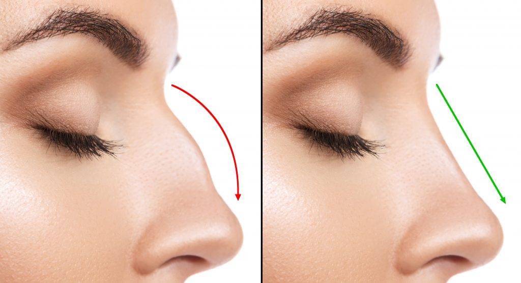Non surgical Rhinoplasty and nose remodelling